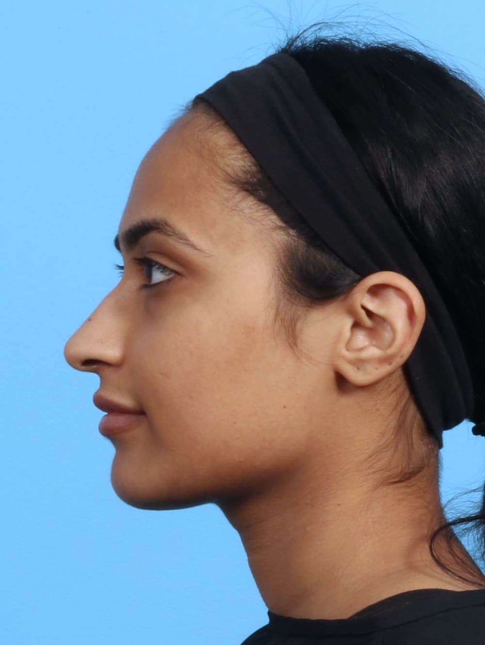 Rhinoplasty case #2979 before, image 1