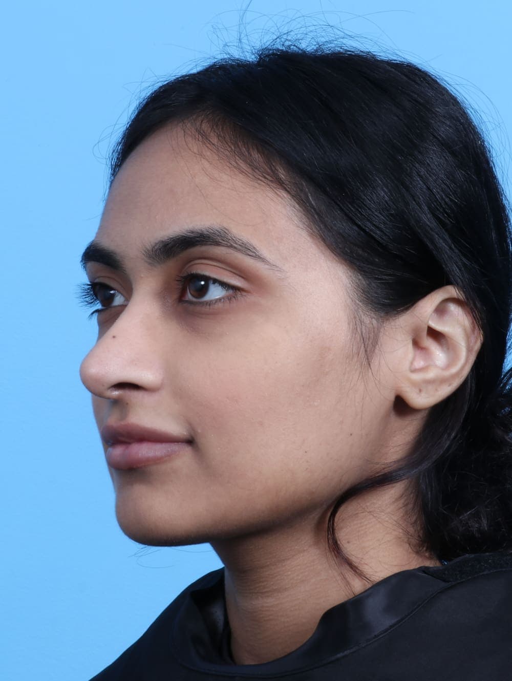 Rhinoplasty case #2979 after, image 3