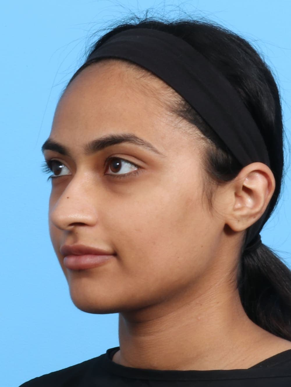Rhinoplasty case #2979 before, image 3