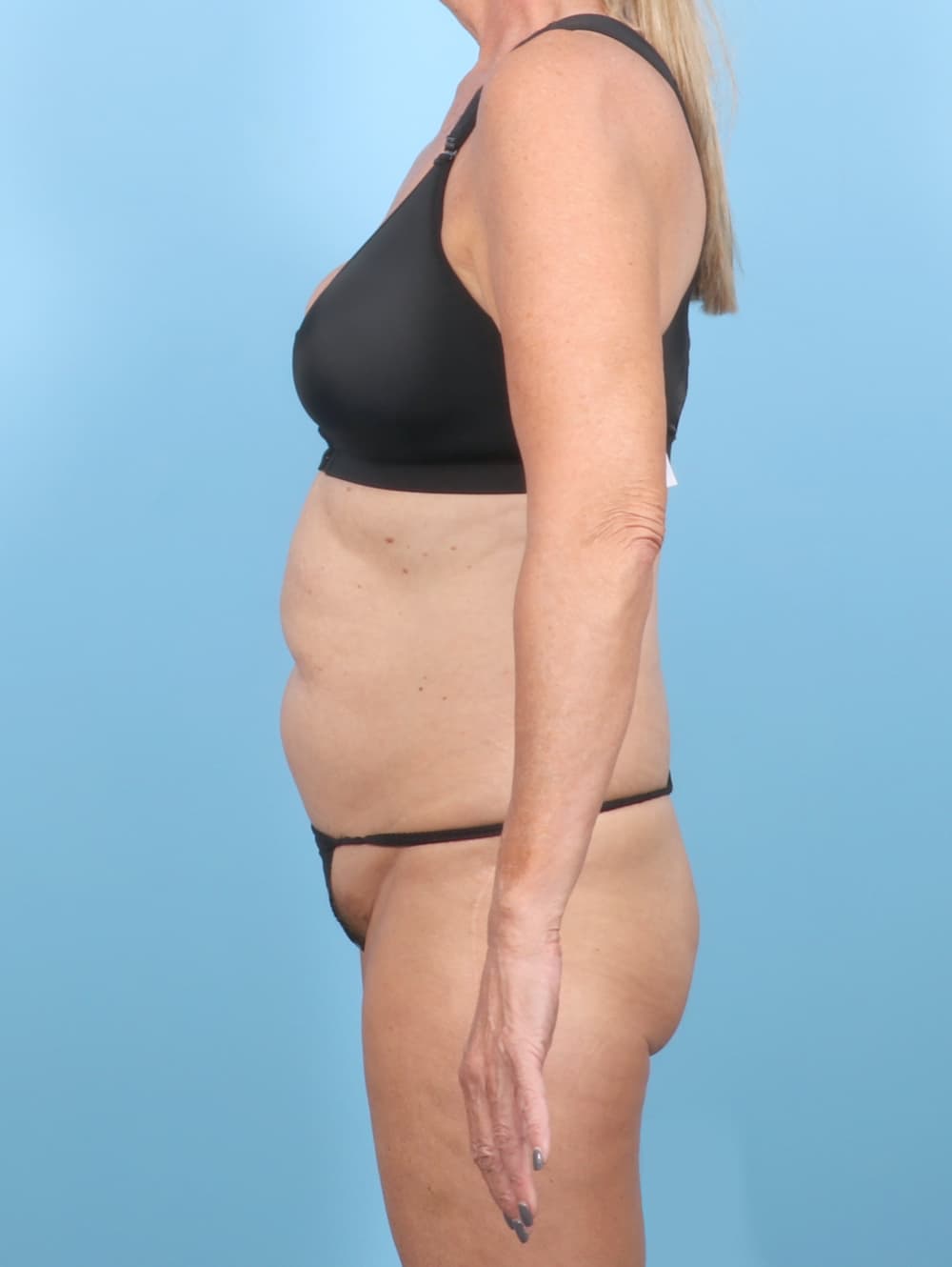 Tummy Tuck case #7726 before, image 3