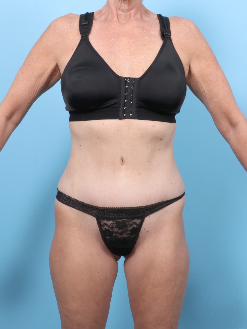 Tummy Tuck case #7726 after