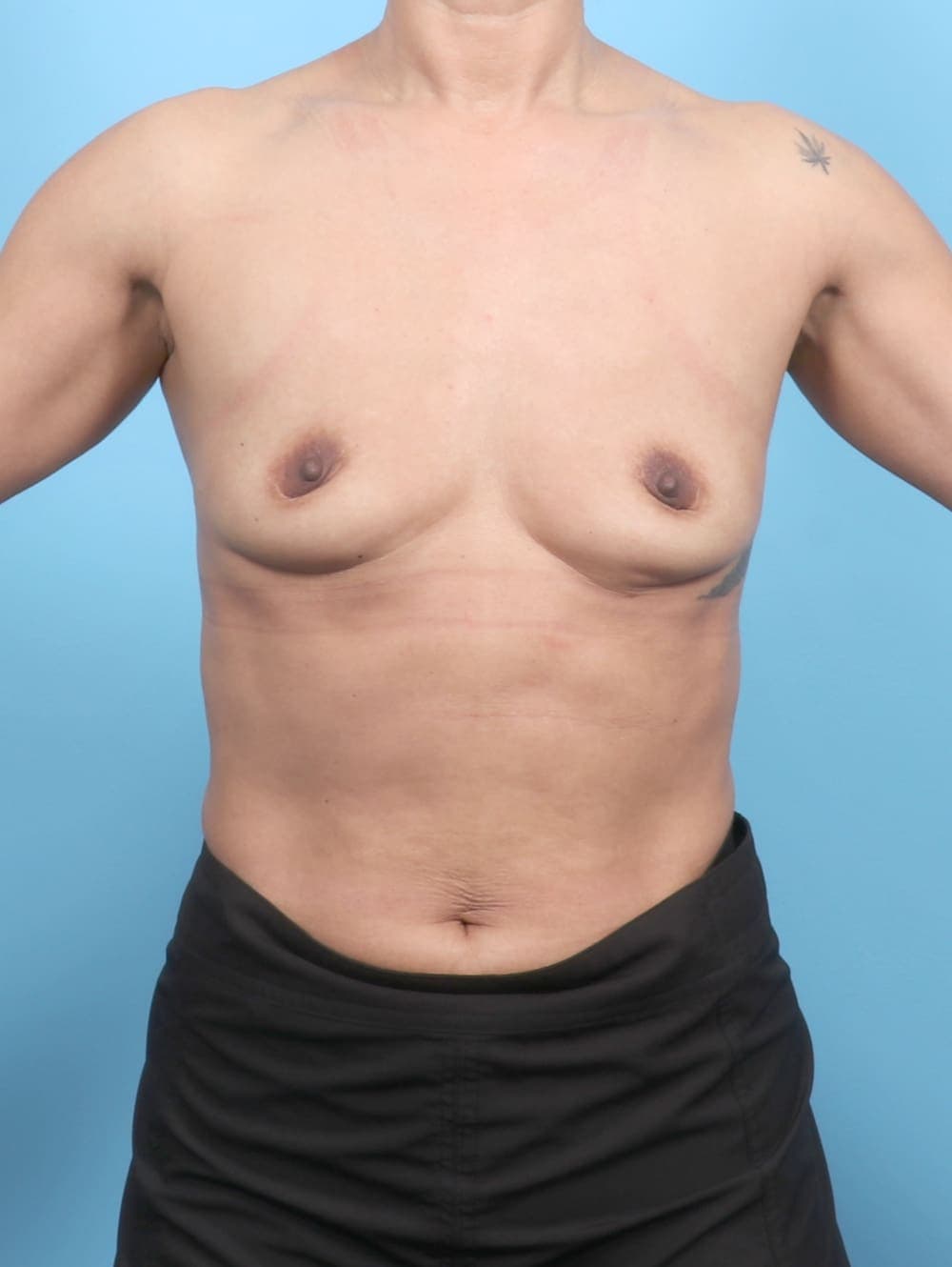 Breast Augmentation case #6669 before