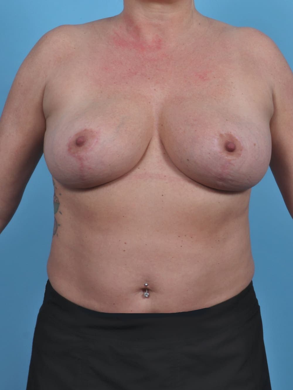 Breast Lift/Reduction case #4926 after