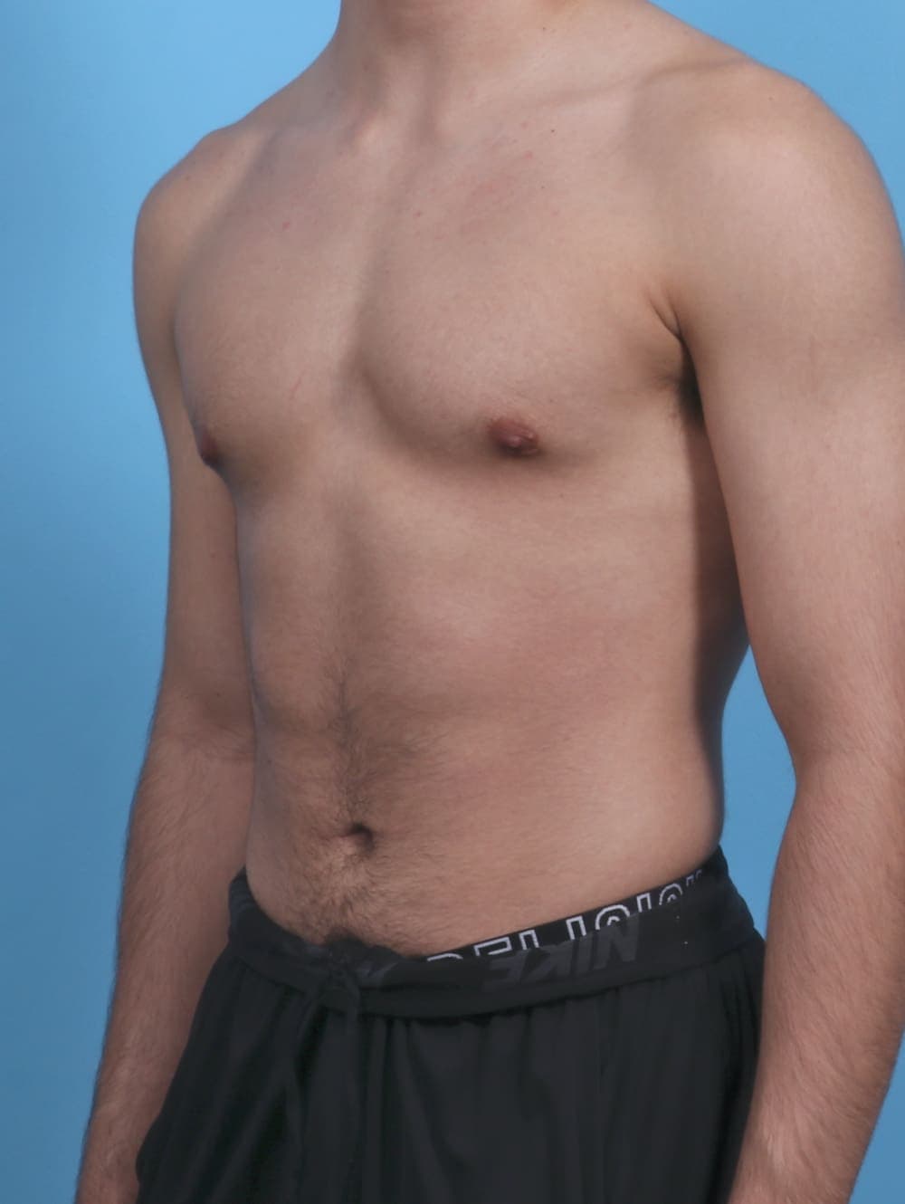 Male Breast Reduction case #3906 after, image 2