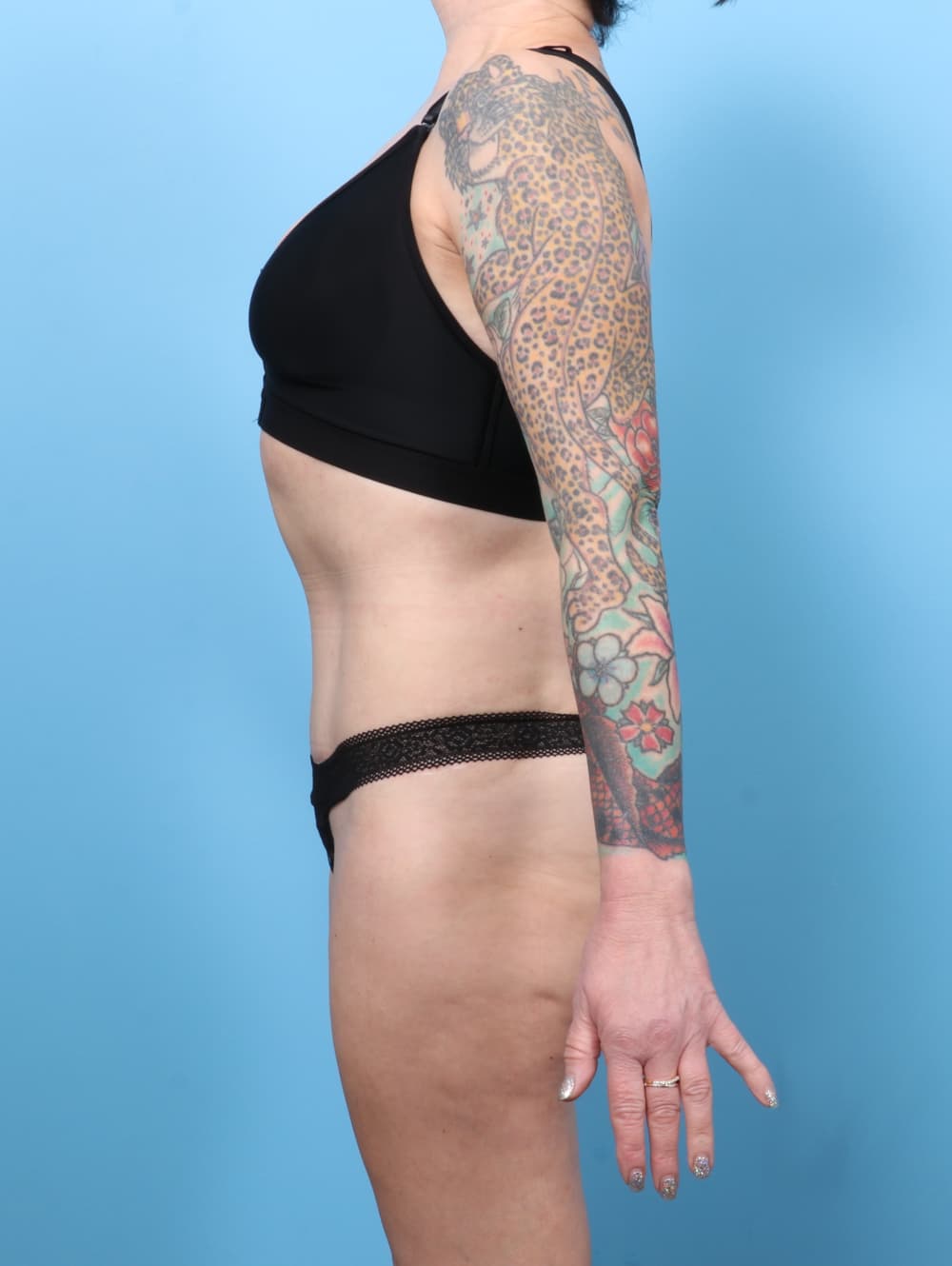 Liposuction case #7676 after, image 3