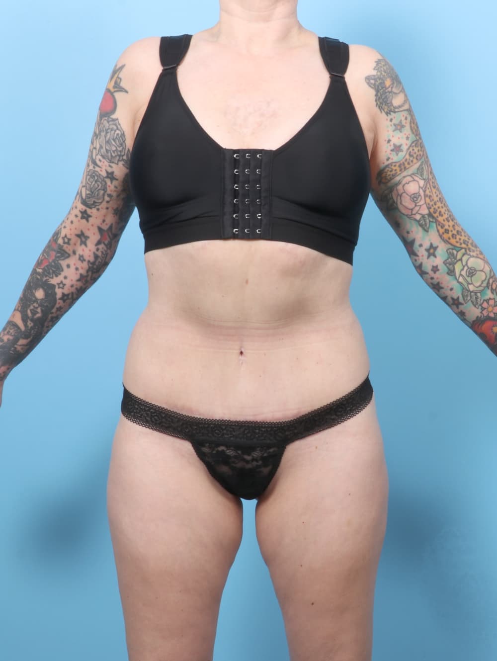 Tummy Tuck case #7676 after