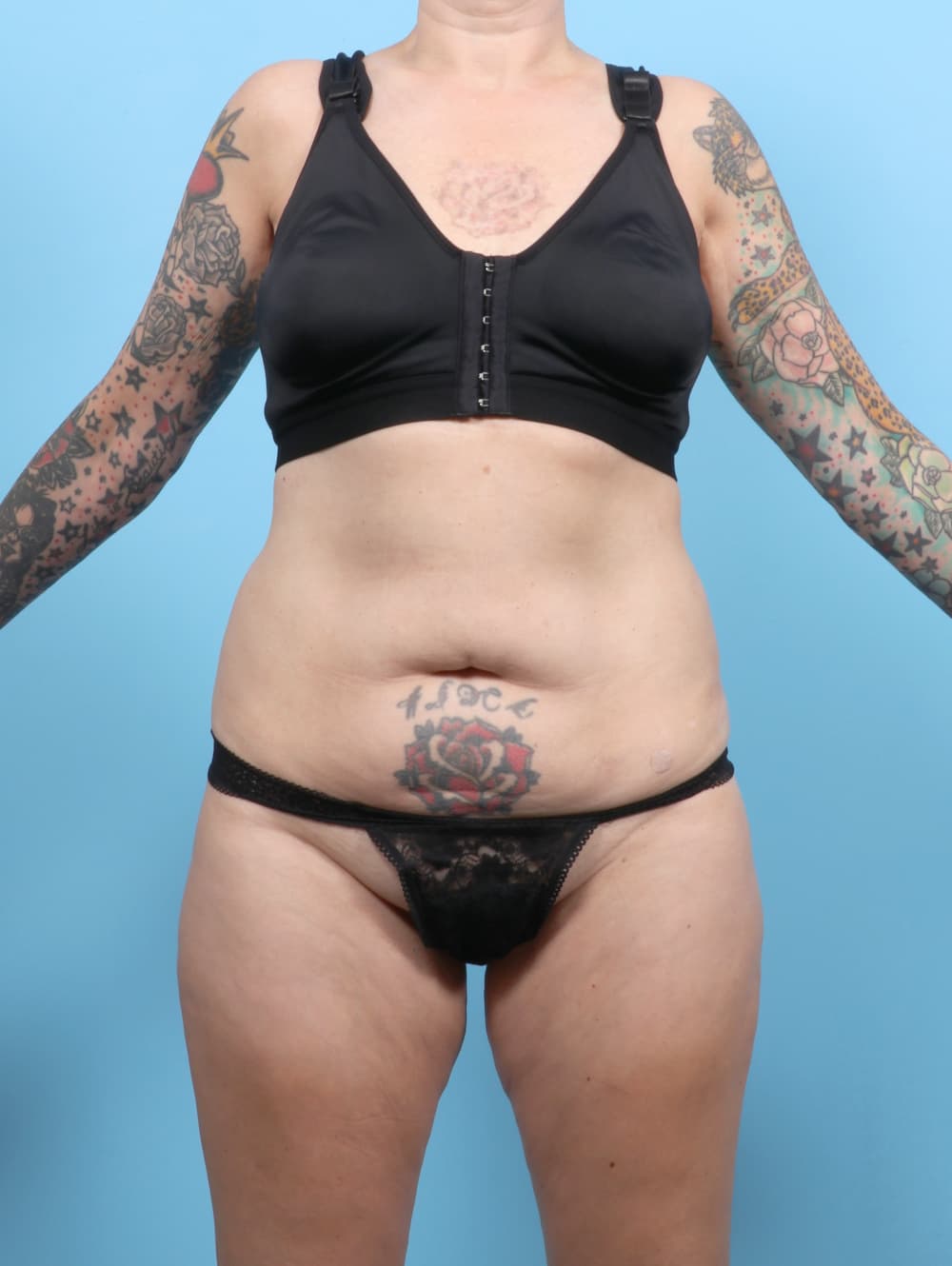 Tummy Tuck case #7676 before