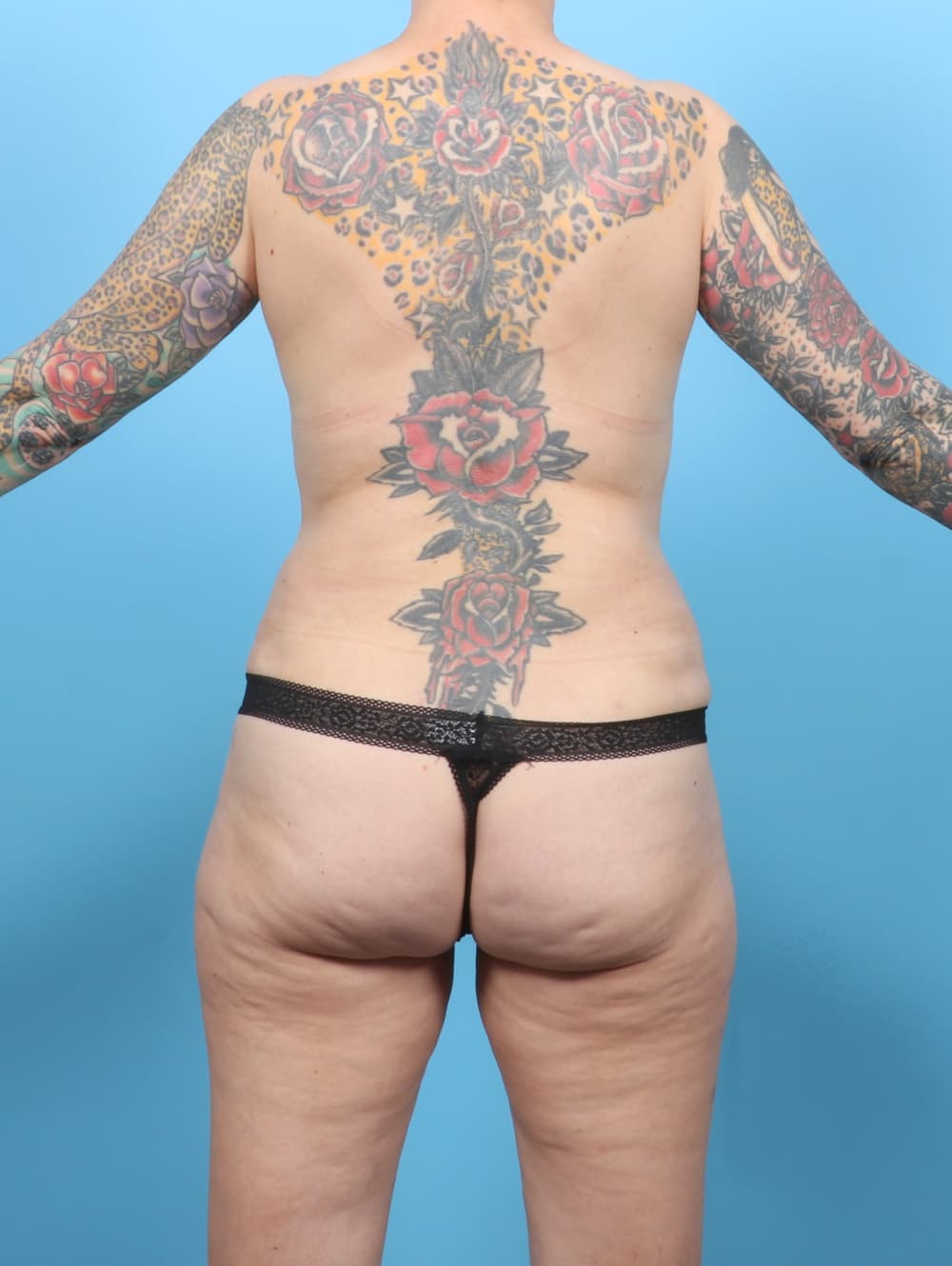 Liposuction case #7676 after, image 4