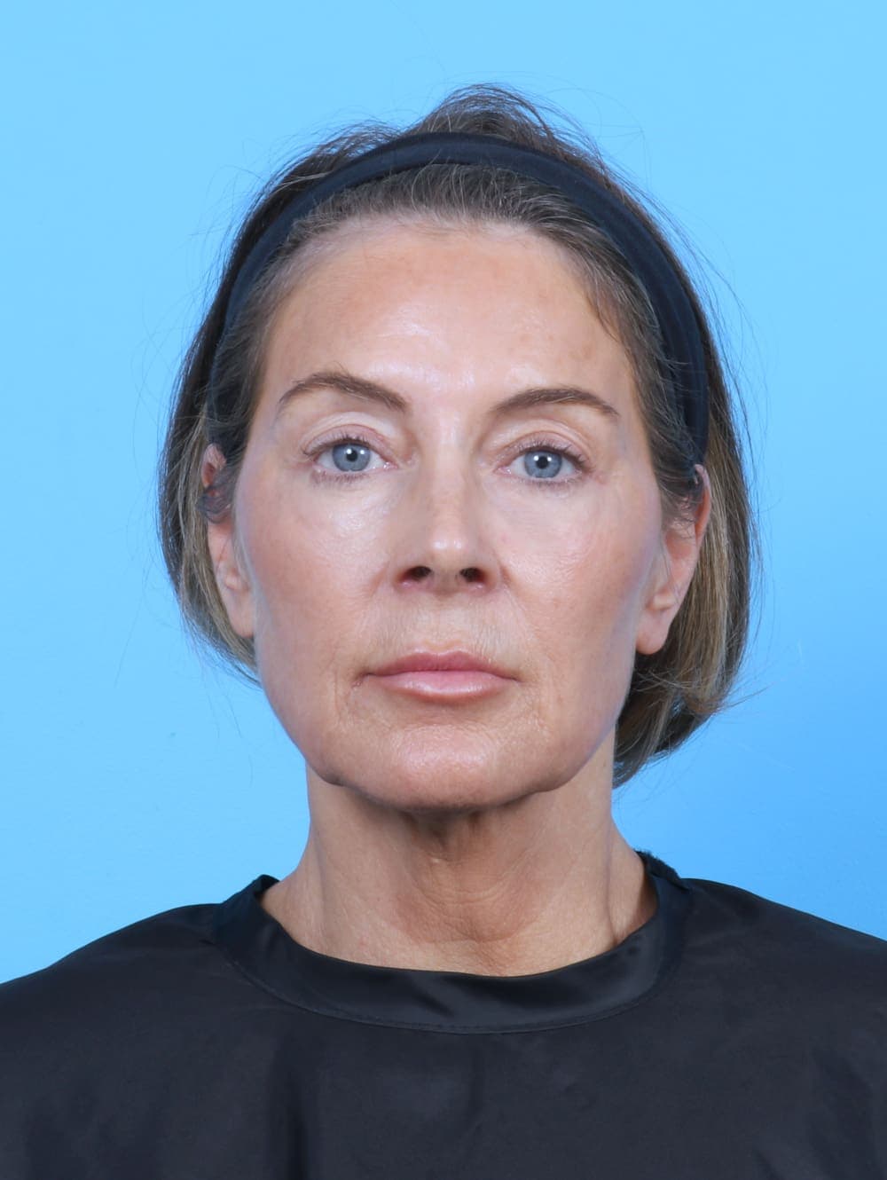 Eyelid Surgery case #5865 after