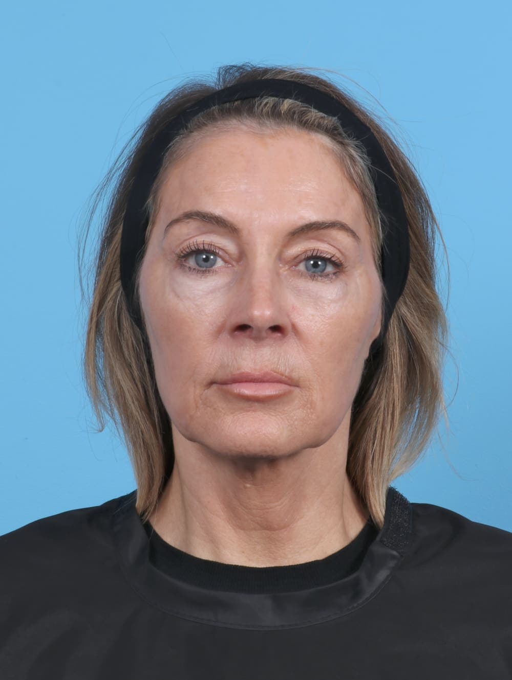 Eyelid Surgery case #5865 before