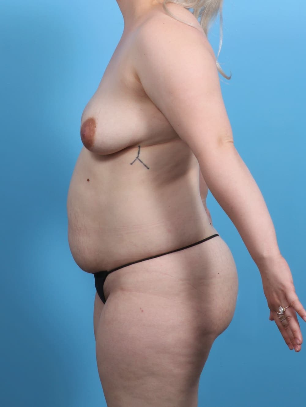 Mommy Makeover case #4081 before, image 4