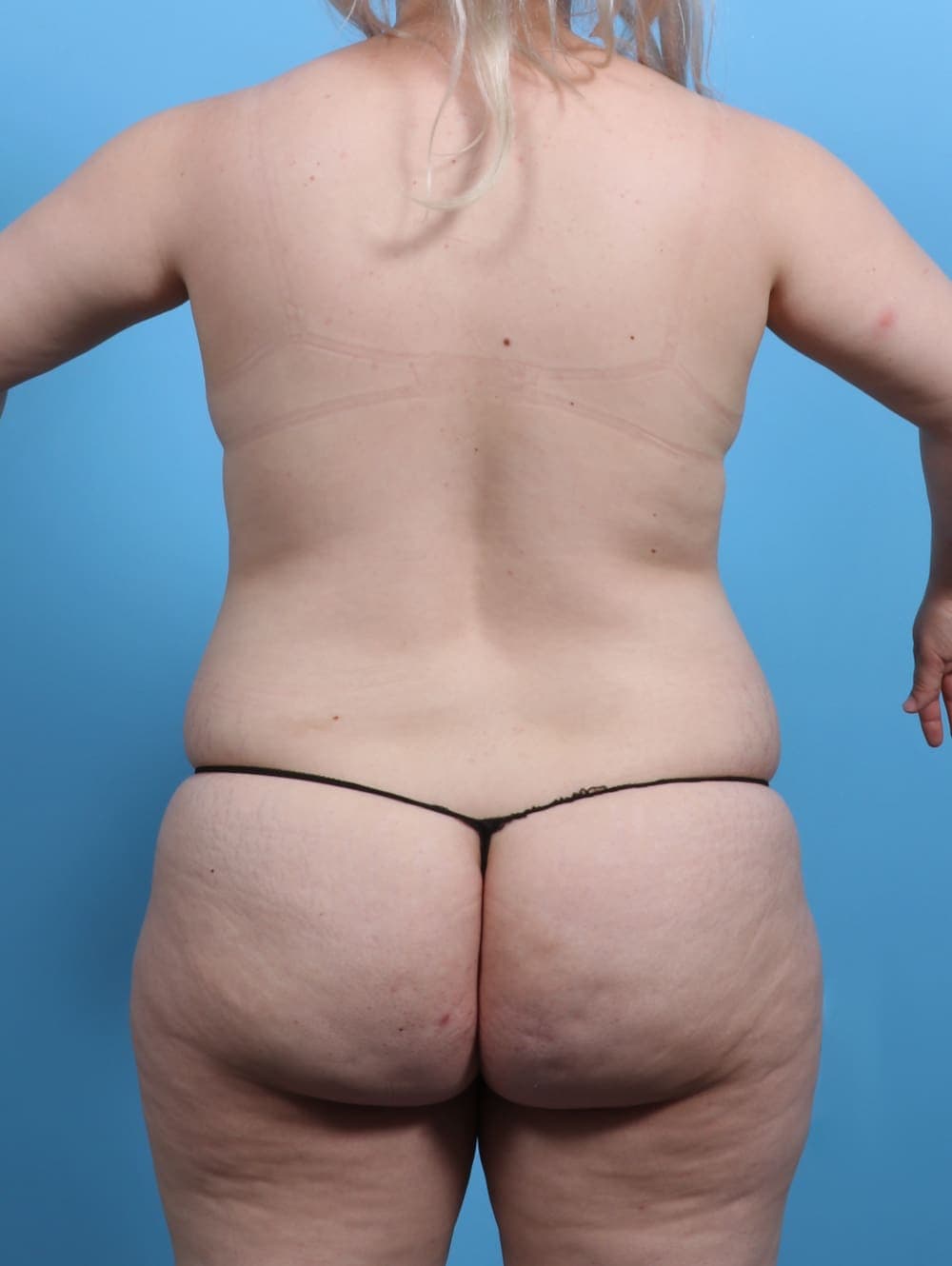 Mommy Makeover case #4081 before, image 2