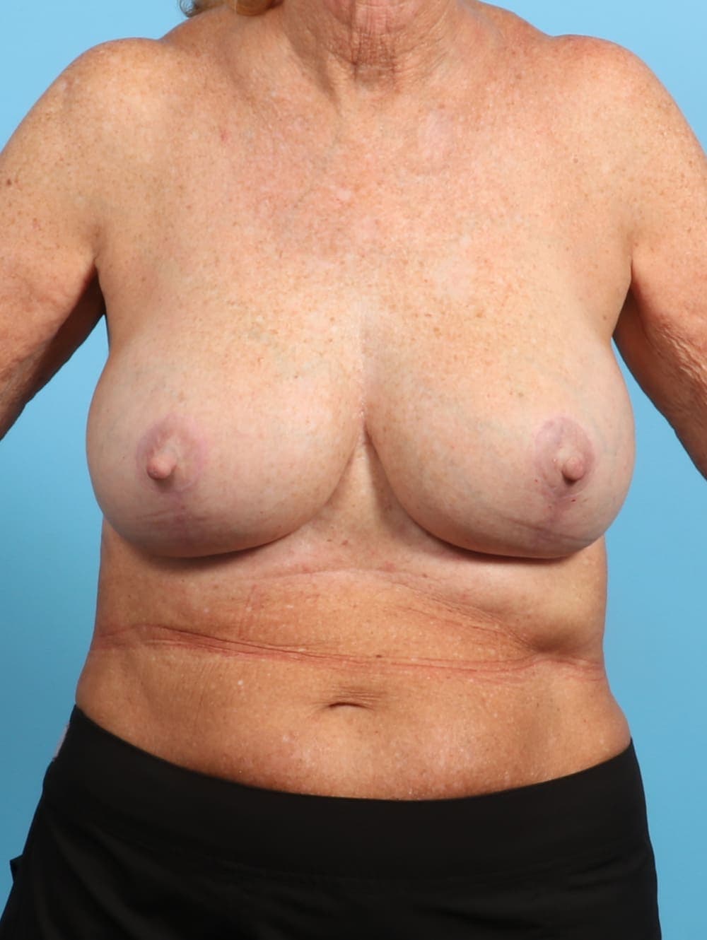 Breast Implant Revision case #2663 after, image 1