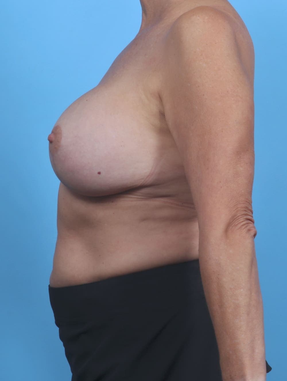Breast Lift with Implants case #3951 after, image 3