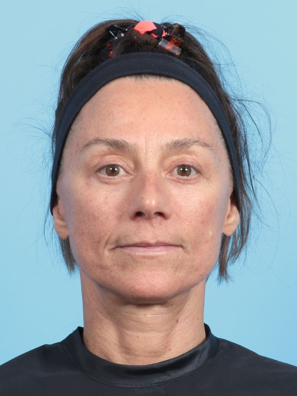 Facial Surgery case #2536 after