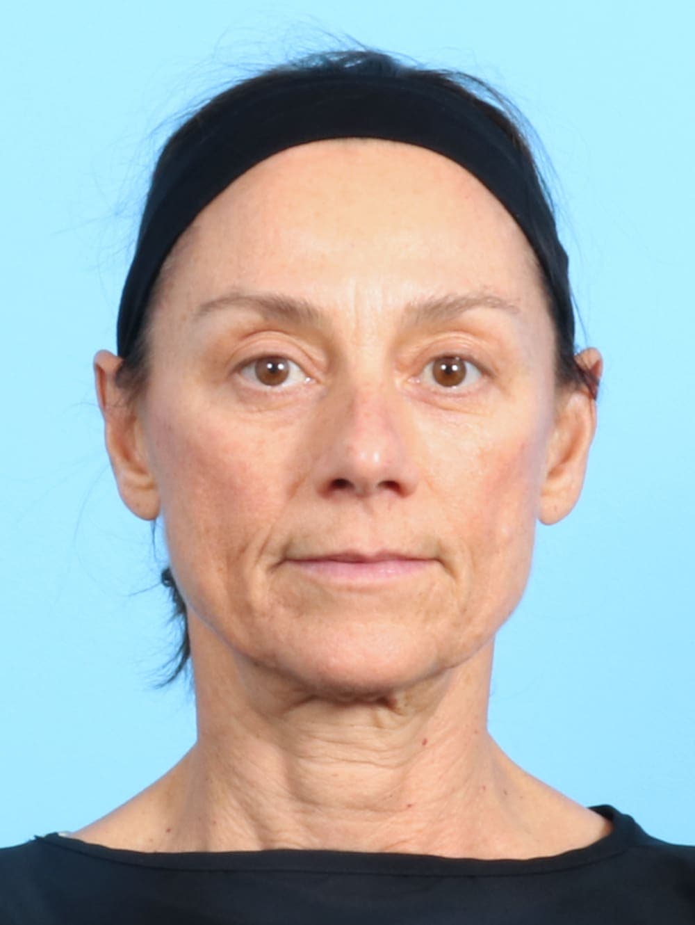 Facial Surgery case #2536 before