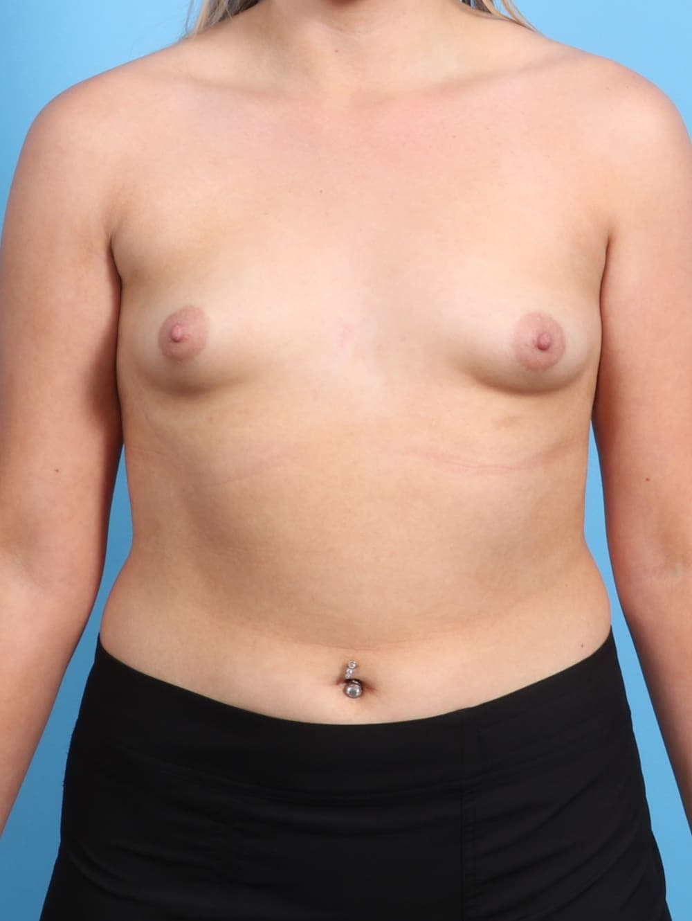 Breast Augmentation case #2931 before, image 1