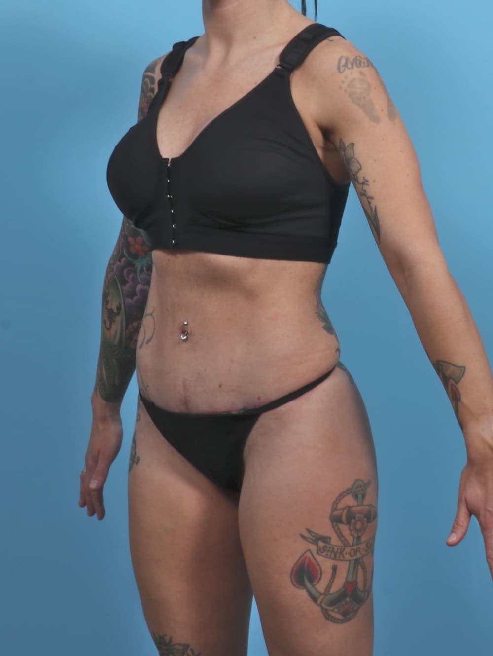 Tummy Tuck case #4884 after, image 2