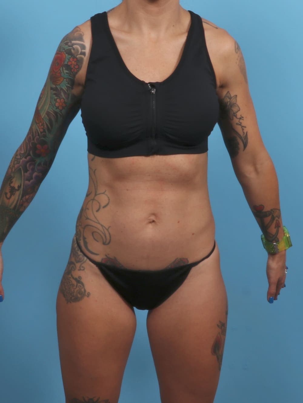Tummy Tuck case #4884 before, image 1