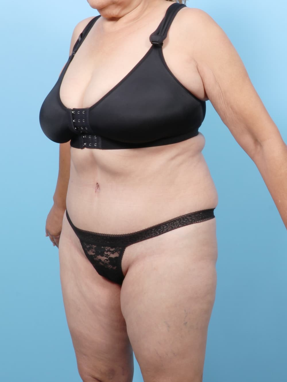Tummy Tuck case #7501 after, image 2