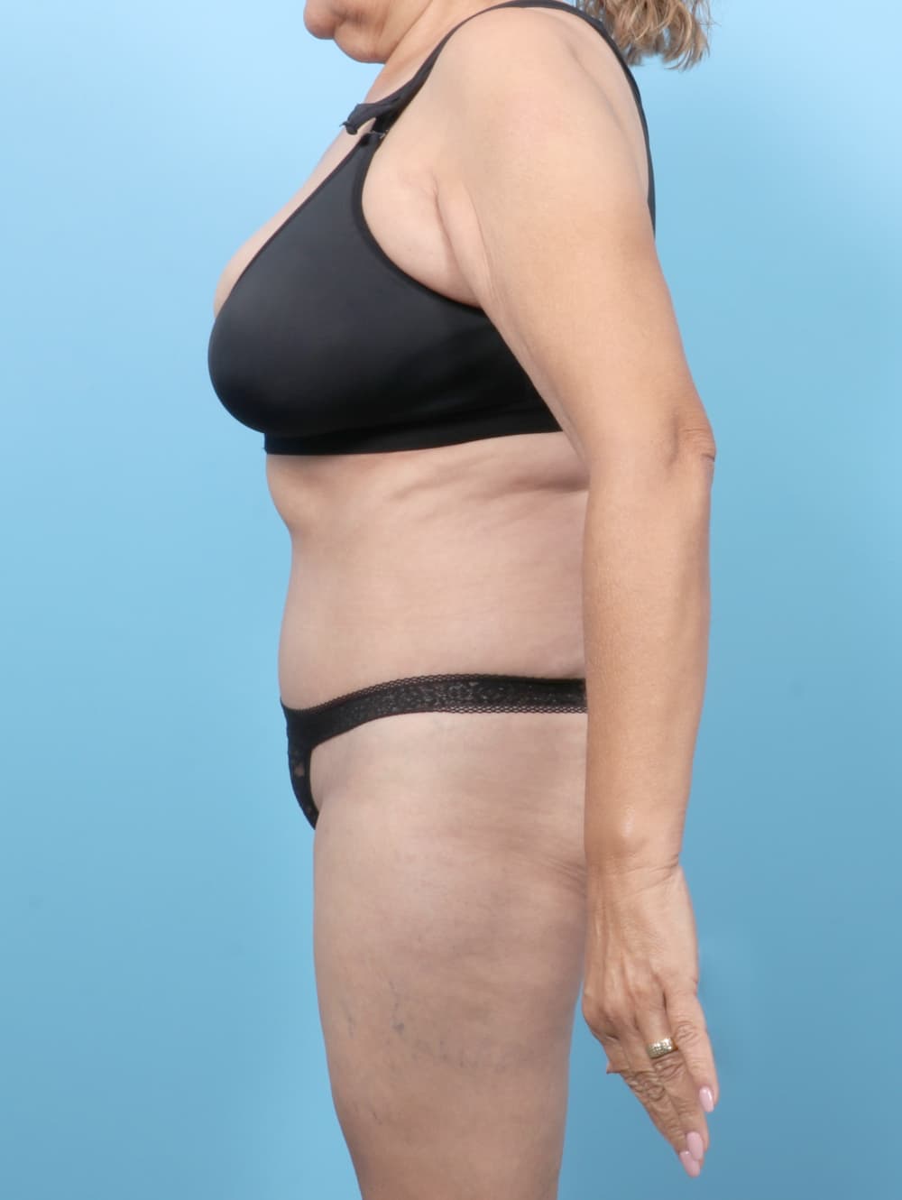 Tummy Tuck case #7501 after, image 3