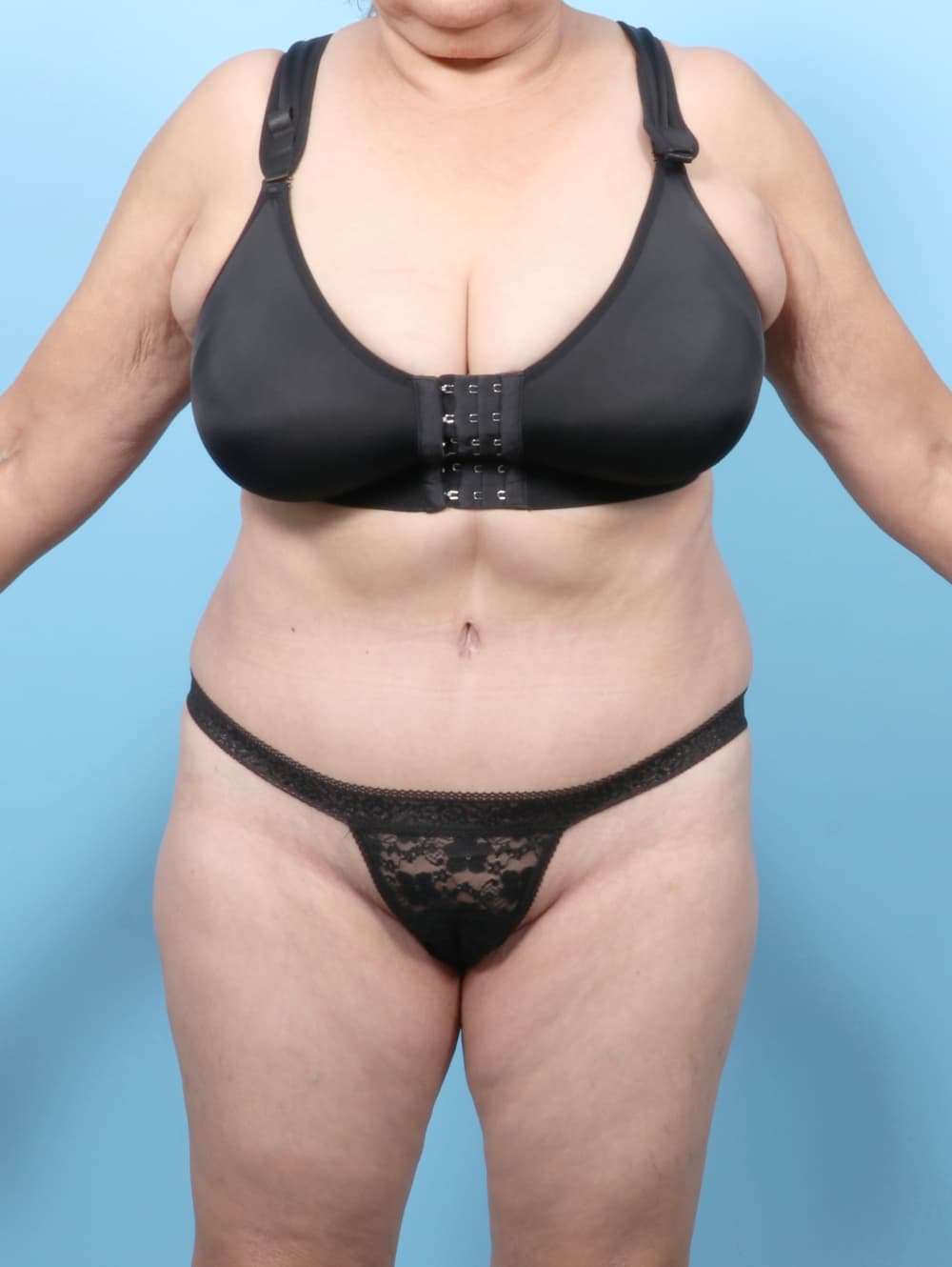 Tummy Tuck case #7501 after
