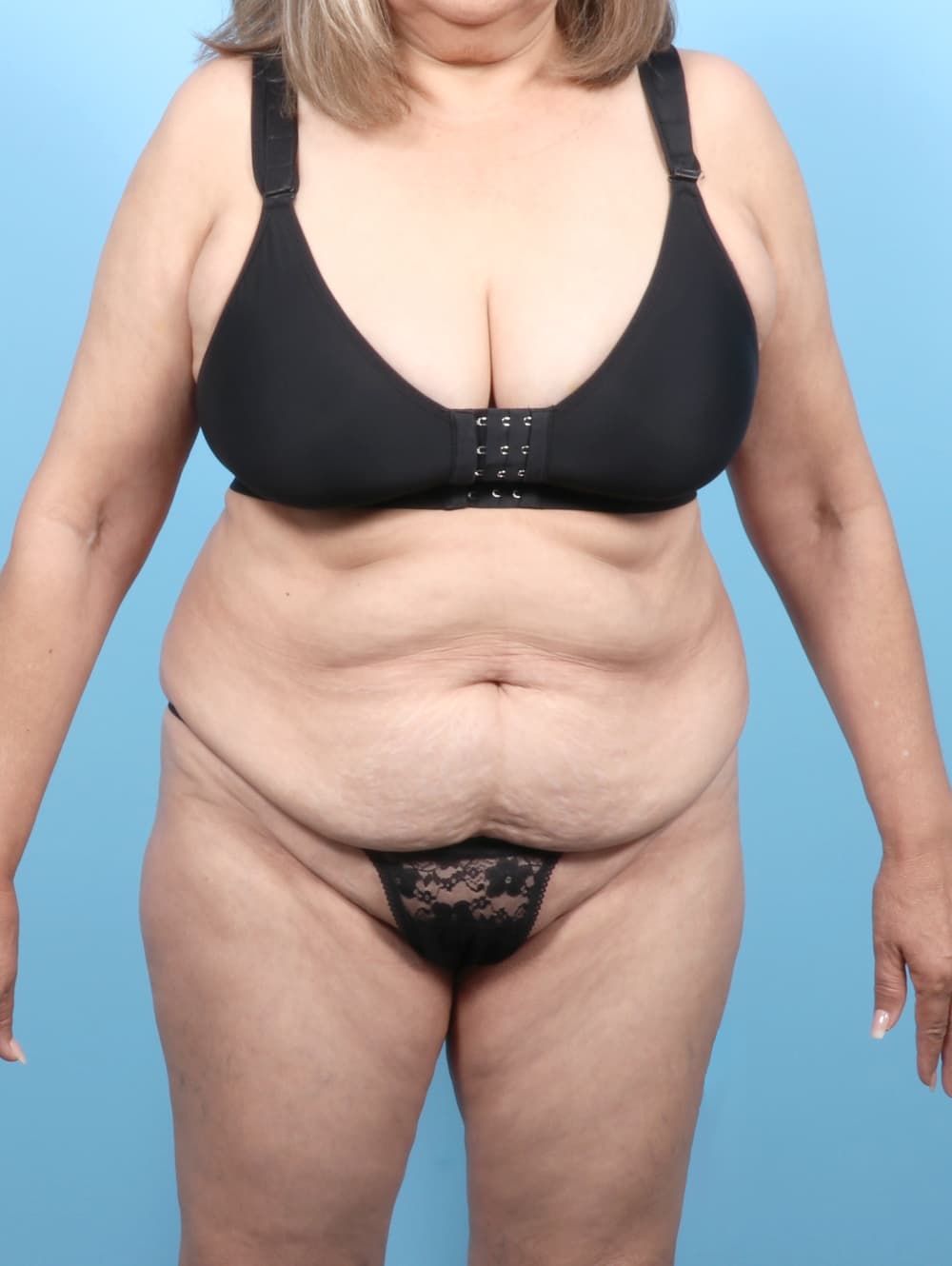 Tummy Tuck case #7501 before