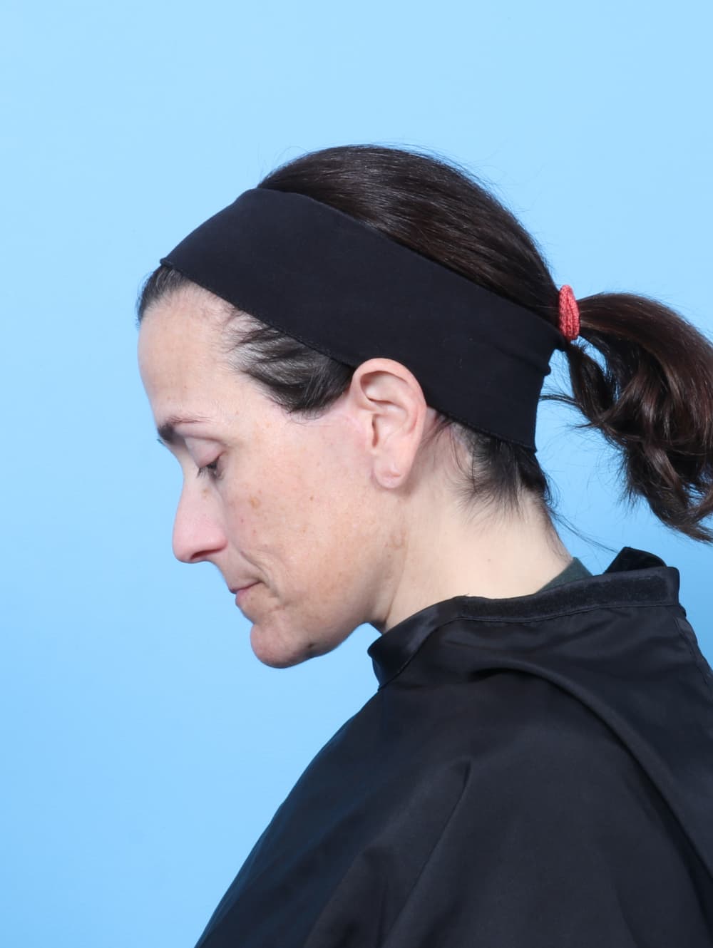Facelift case #8748 after, image 3