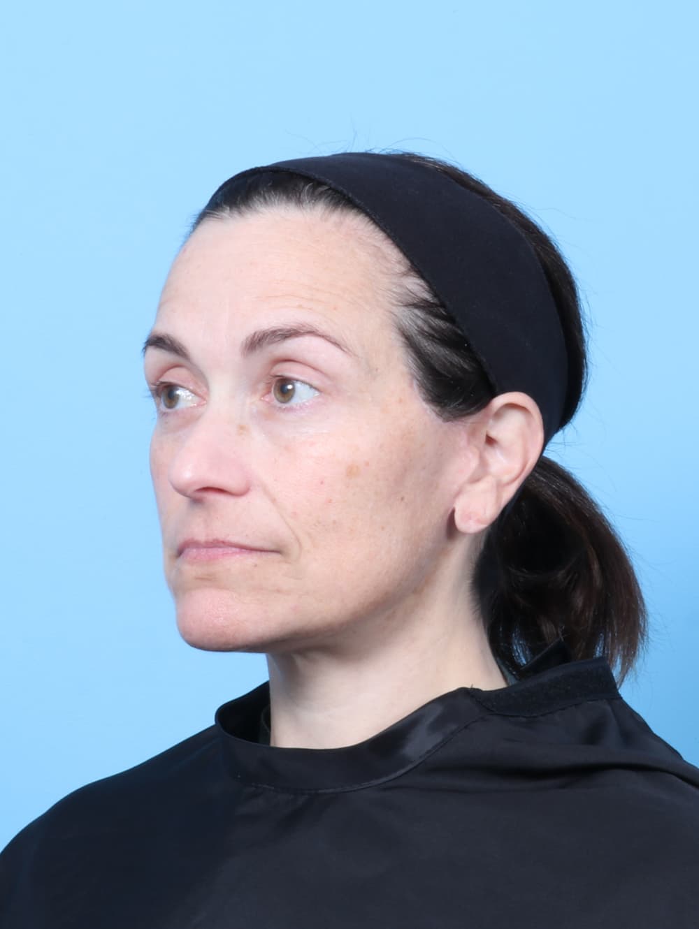 Facelift case #8748 after, image 2