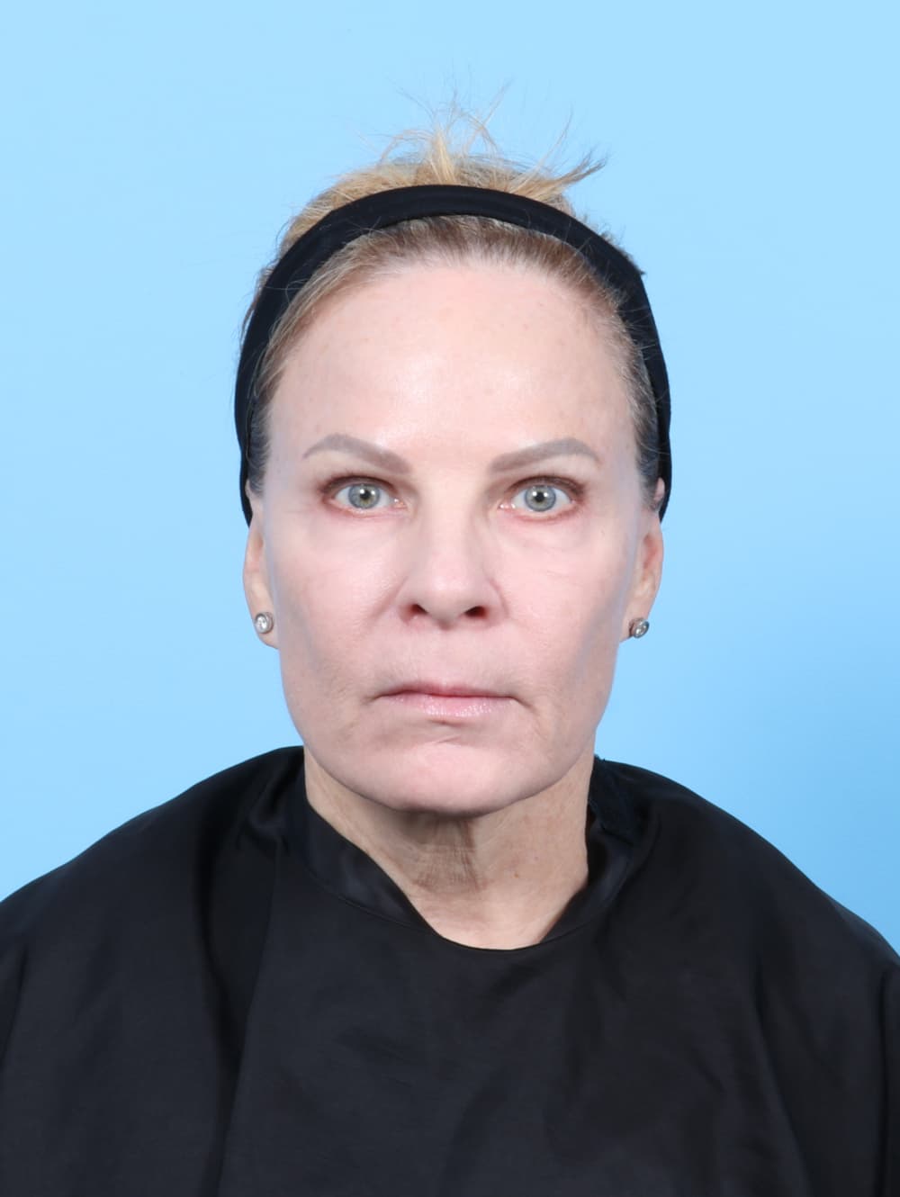 Facial Surgery case #7339 after