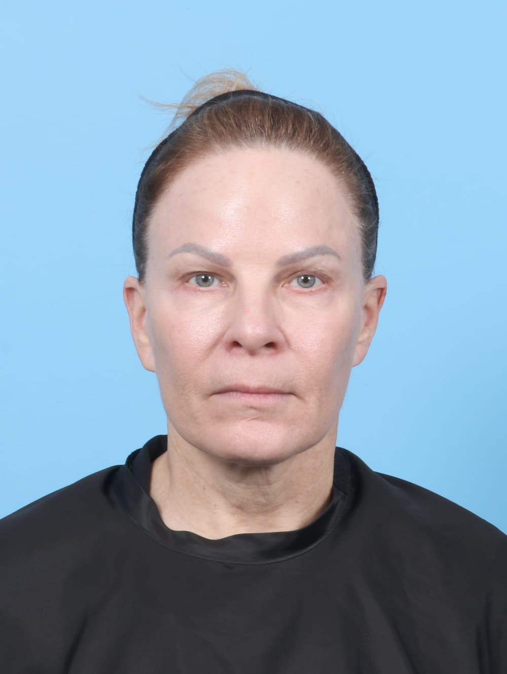 Facial Surgery case #7339 before