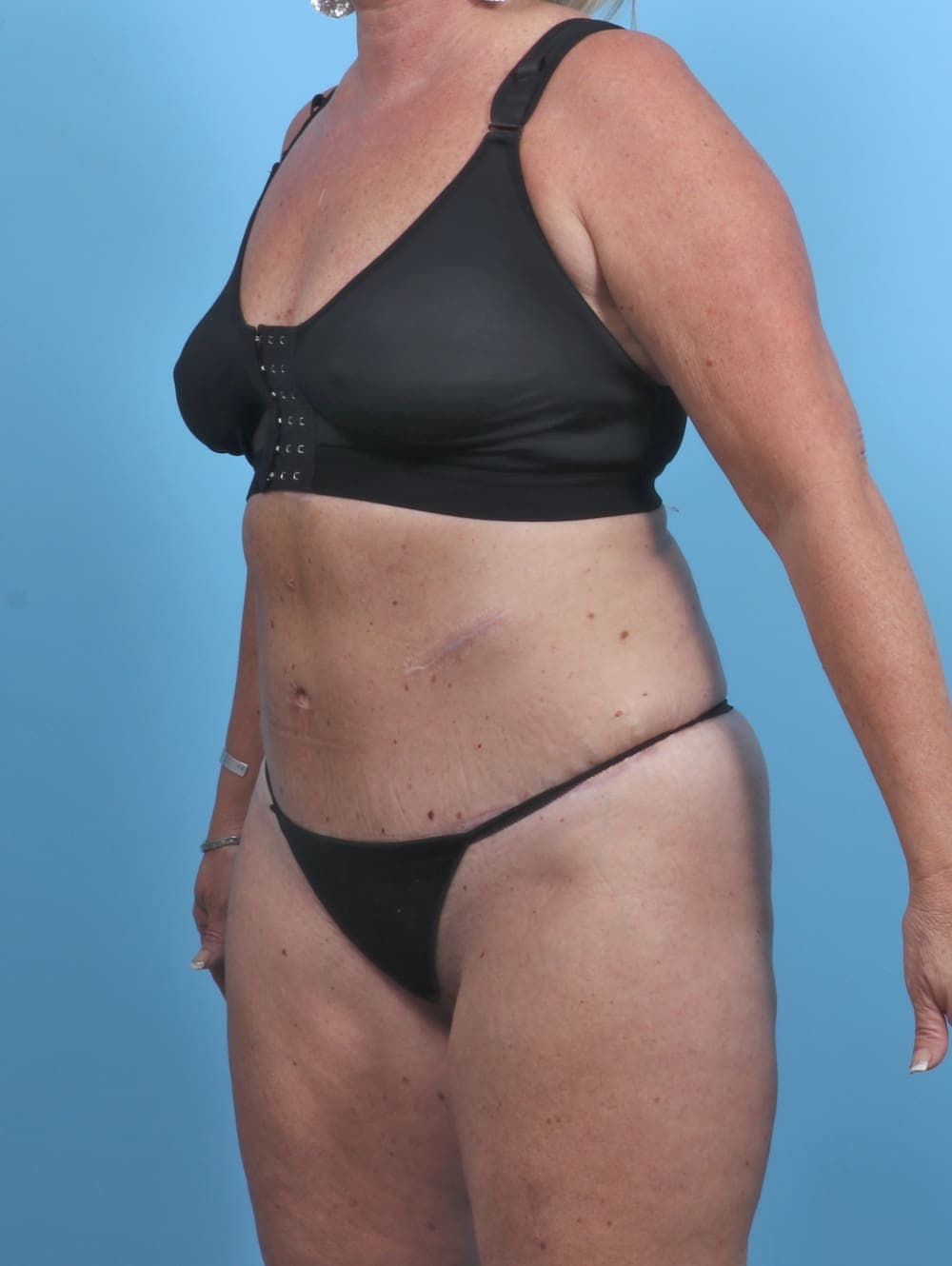 Tummy Tuck case #3914 after, image 3