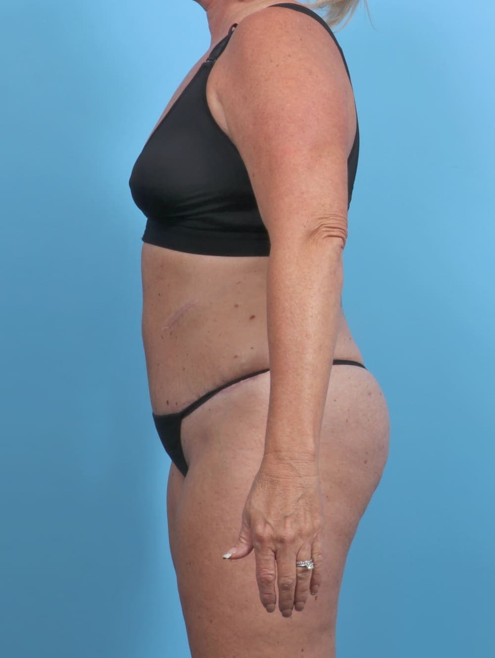 Tummy Tuck case #3914 after, image 4