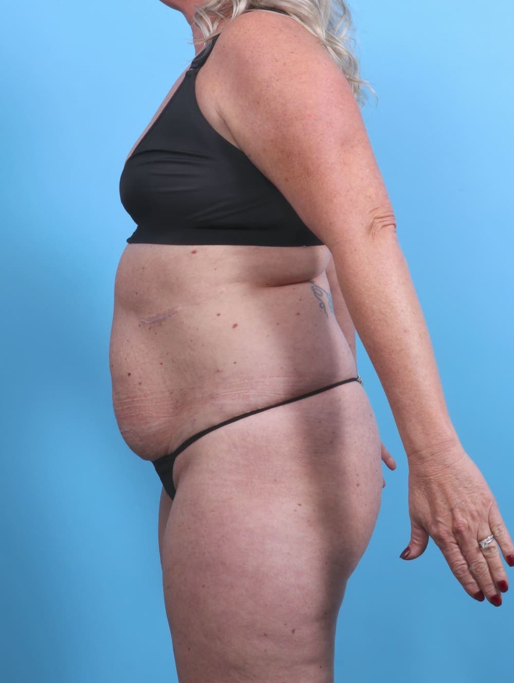 Tummy Tuck case #3914 before, image 4