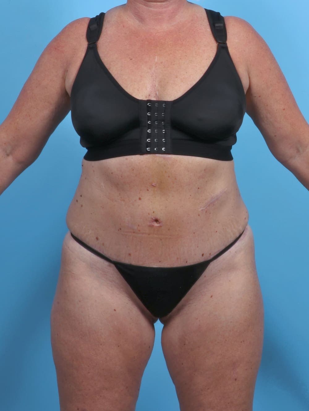 Liposuction case #3914 after