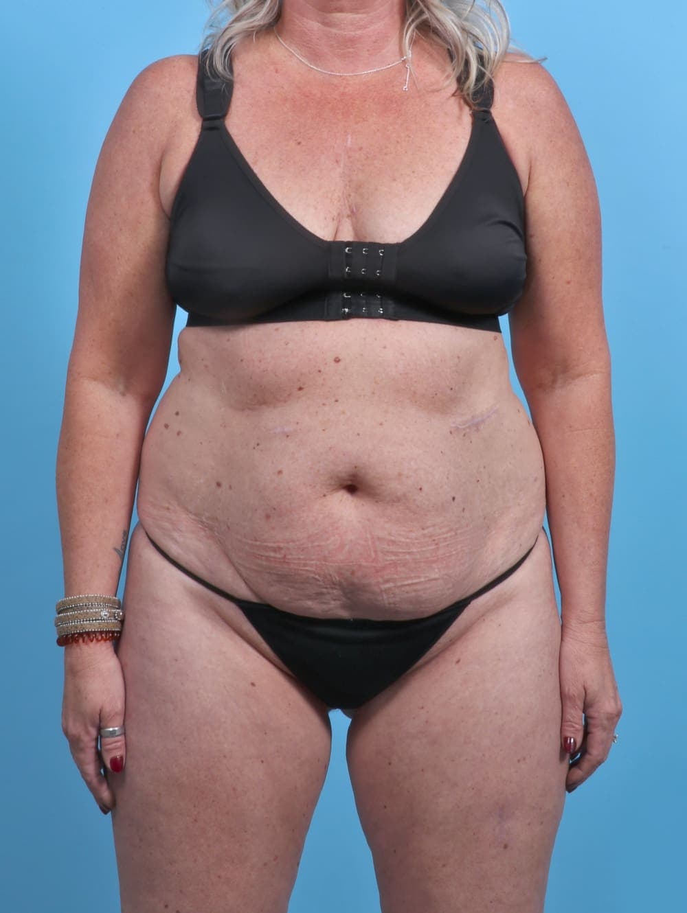 Liposuction case #3914 before