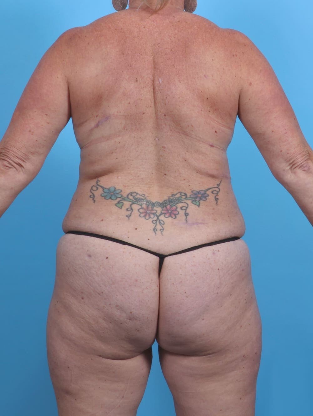 Tummy Tuck case #3914 after, image 2