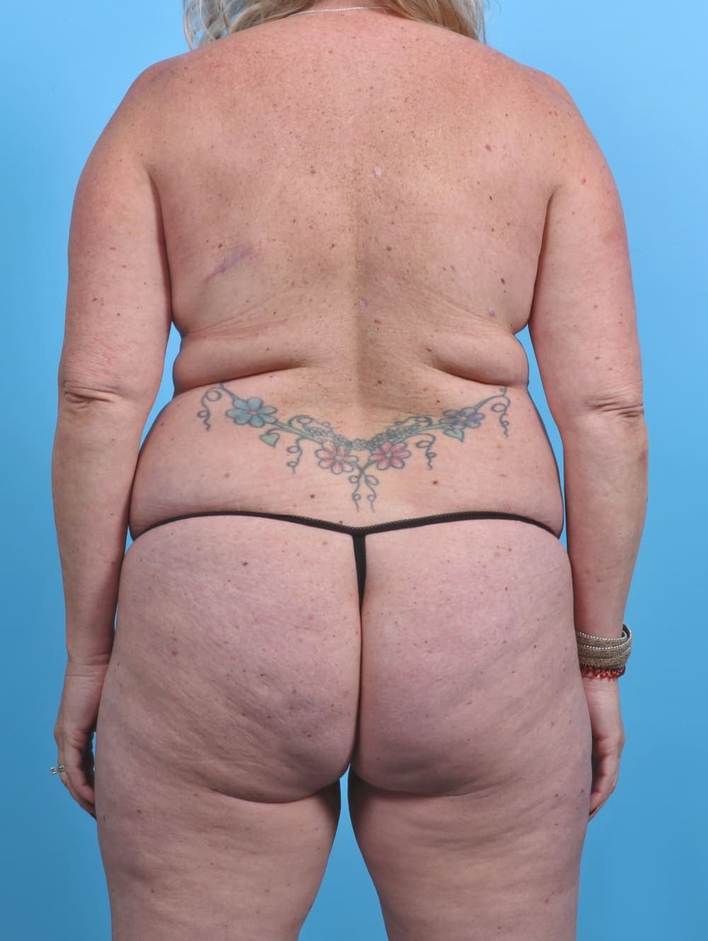 Tummy Tuck case #3914 before, image 2