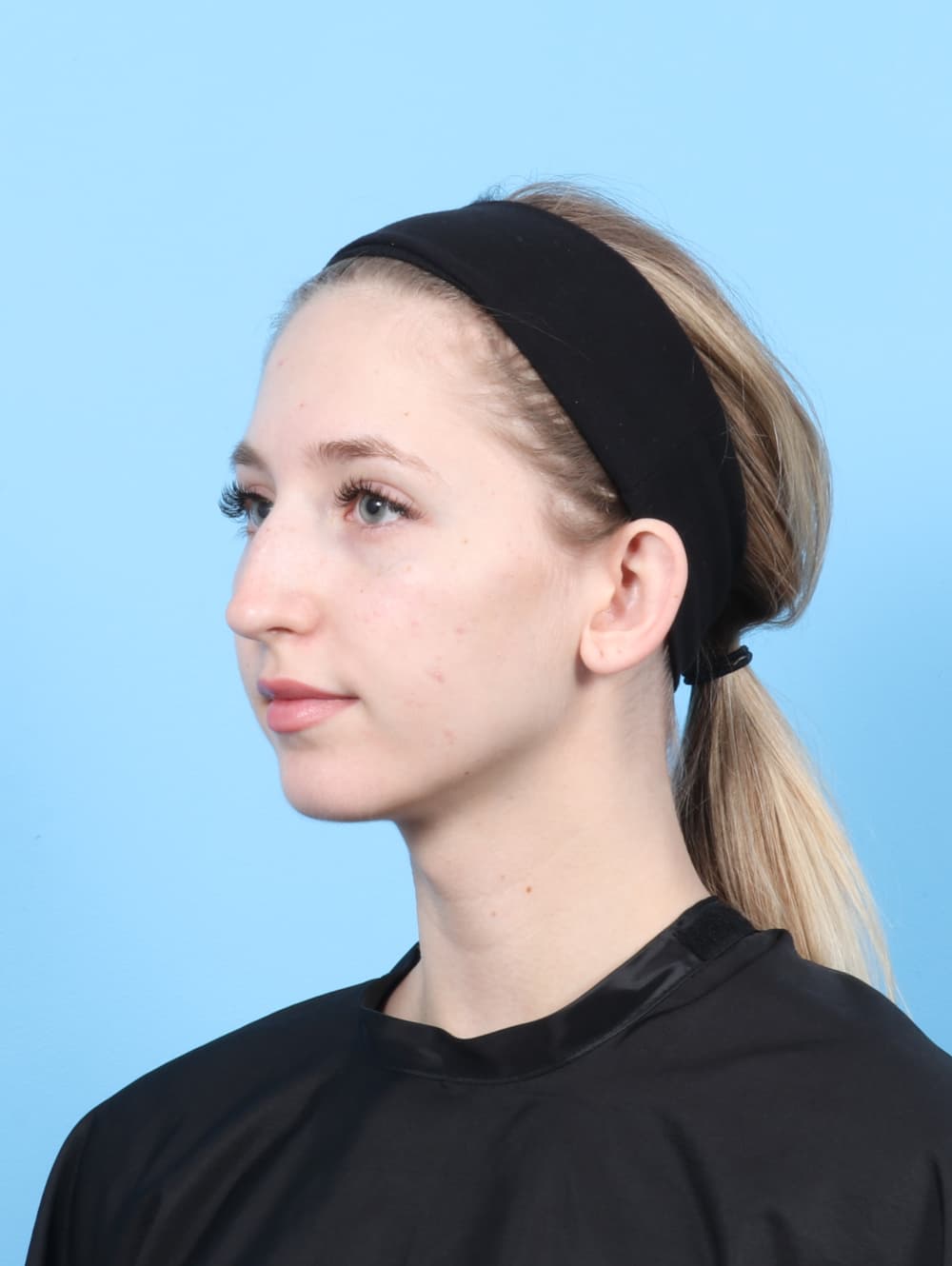 Rhinoplasty case #7477 before, image 3