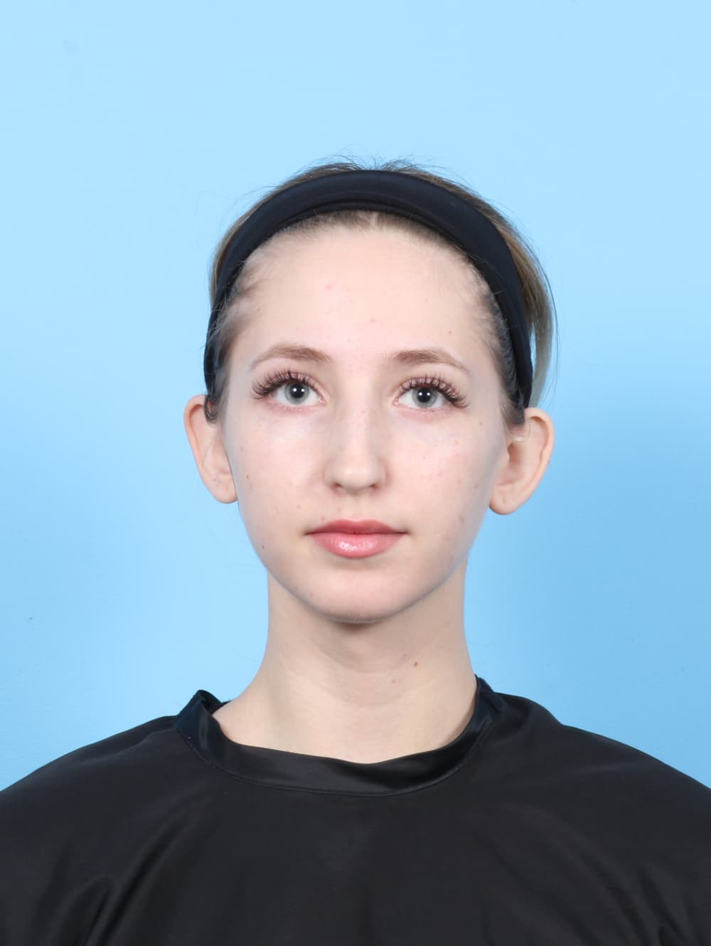 Rhinoplasty case #7477 before, image 2