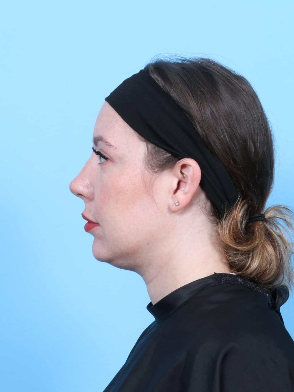 Facial Surgery case #7289 after