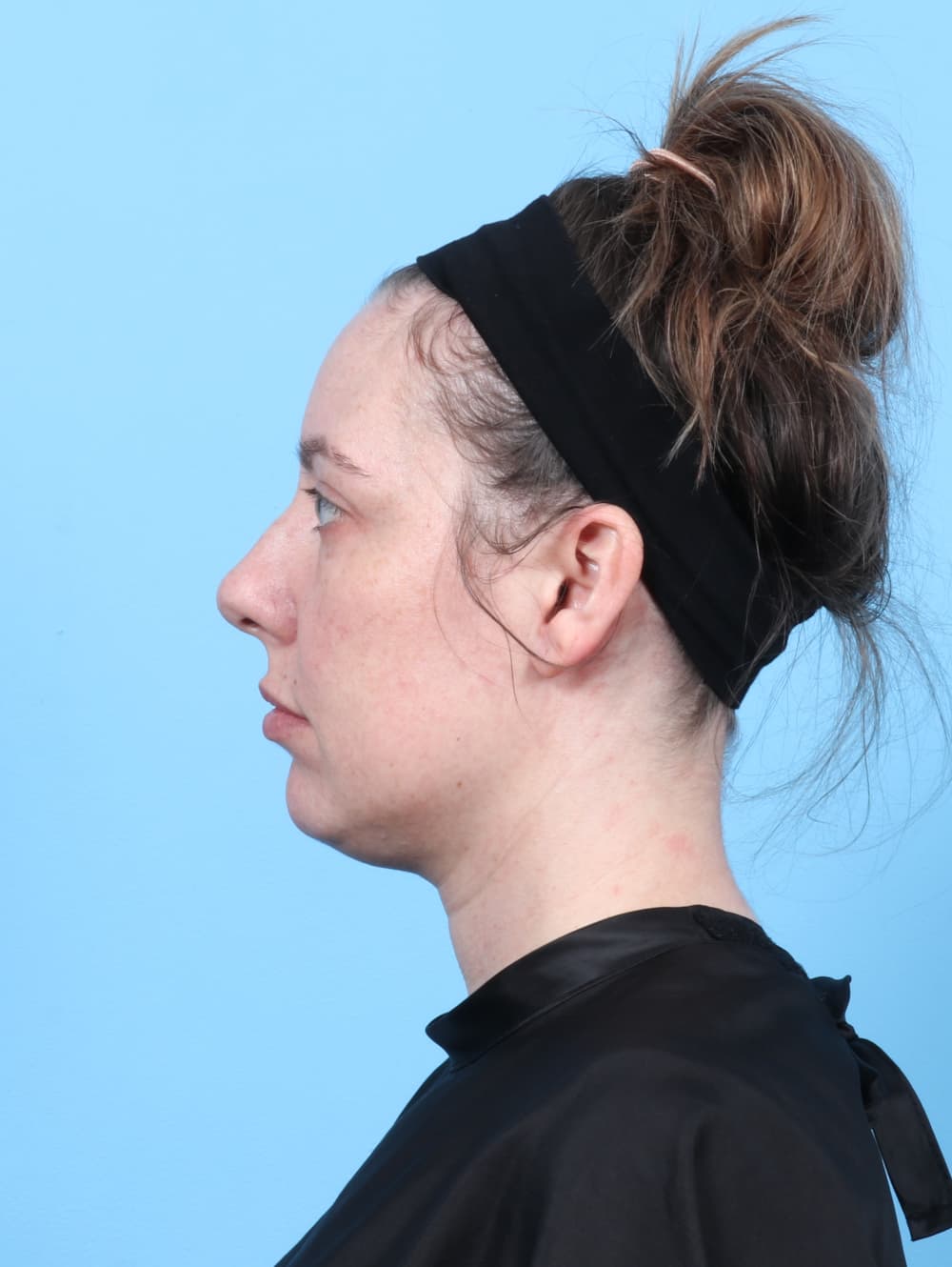Facial Surgery case #7289 before