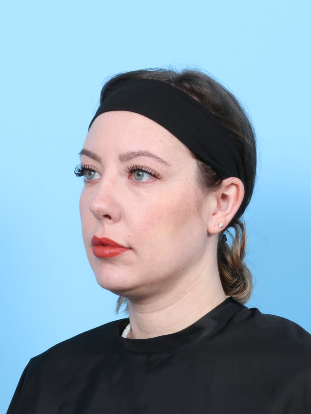 Rhinoplasty case #7289 after, image 3