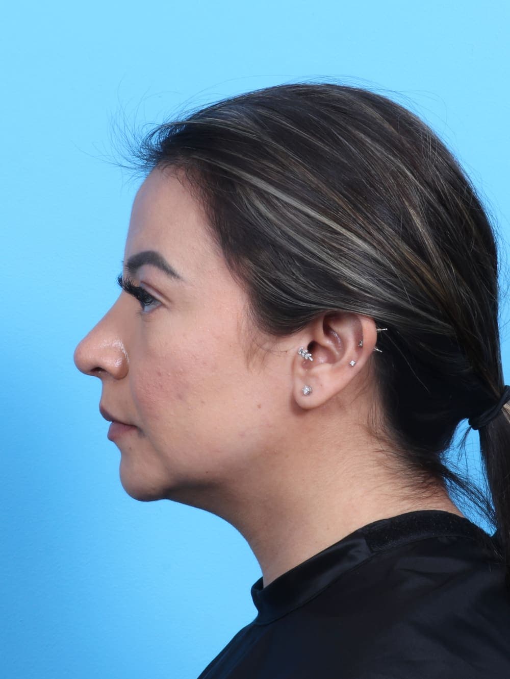 Rhinoplasty case #3279 after, image 1