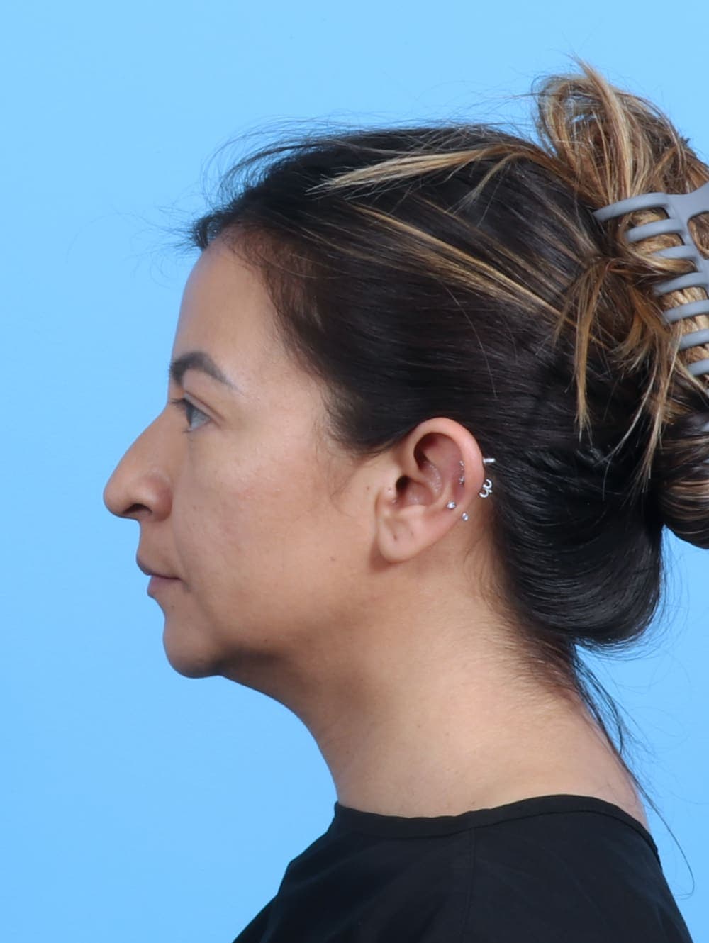Rhinoplasty case #3279 before, image 1