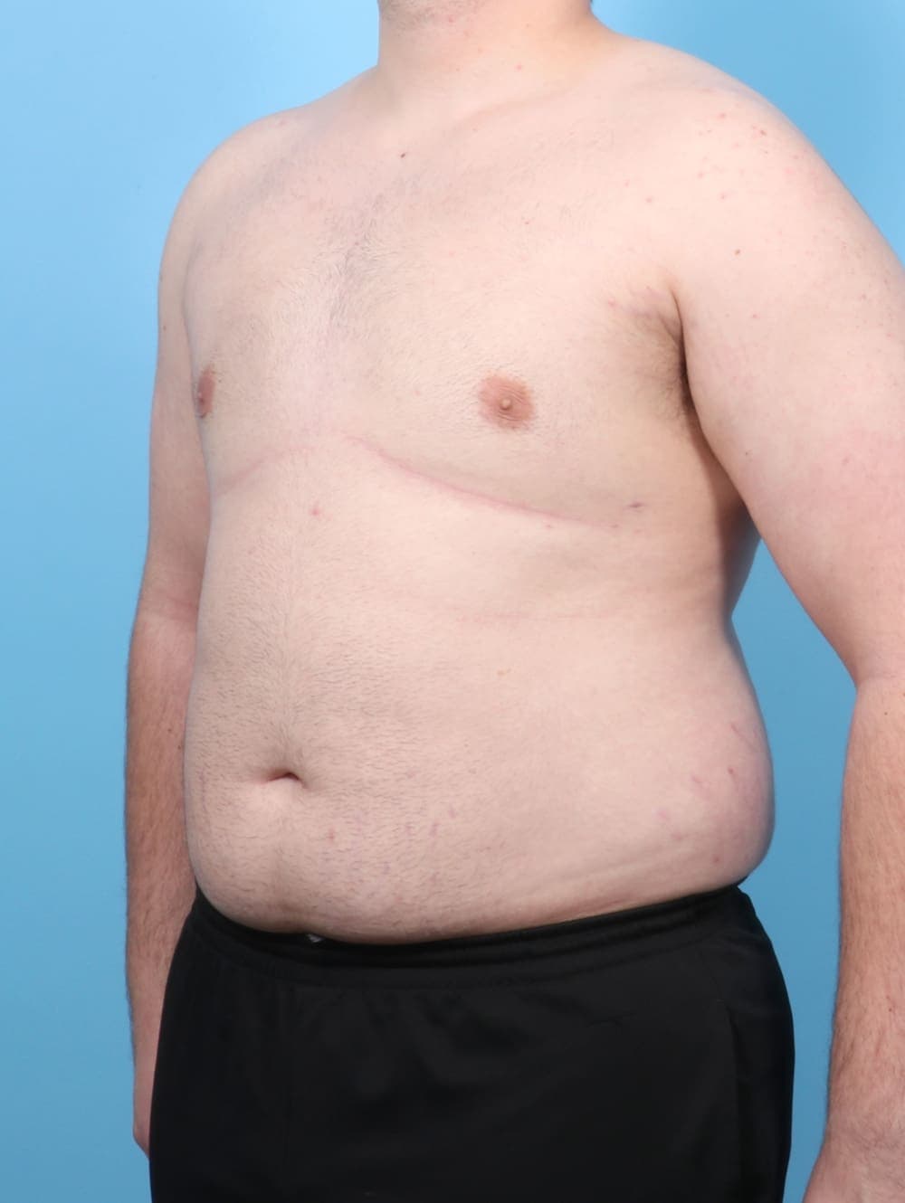 Male Breast Reduction case #6451 after, image 2