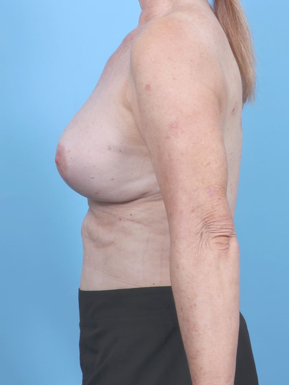 Breast Implant Revision case #6853 after, image 3