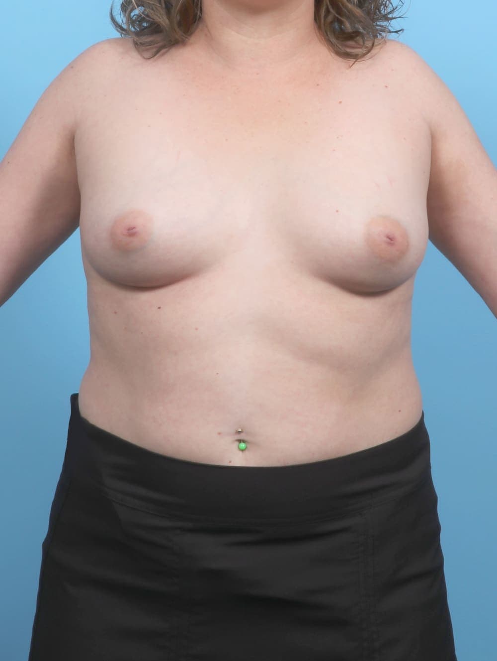 Breast Augmentation case #6759 before