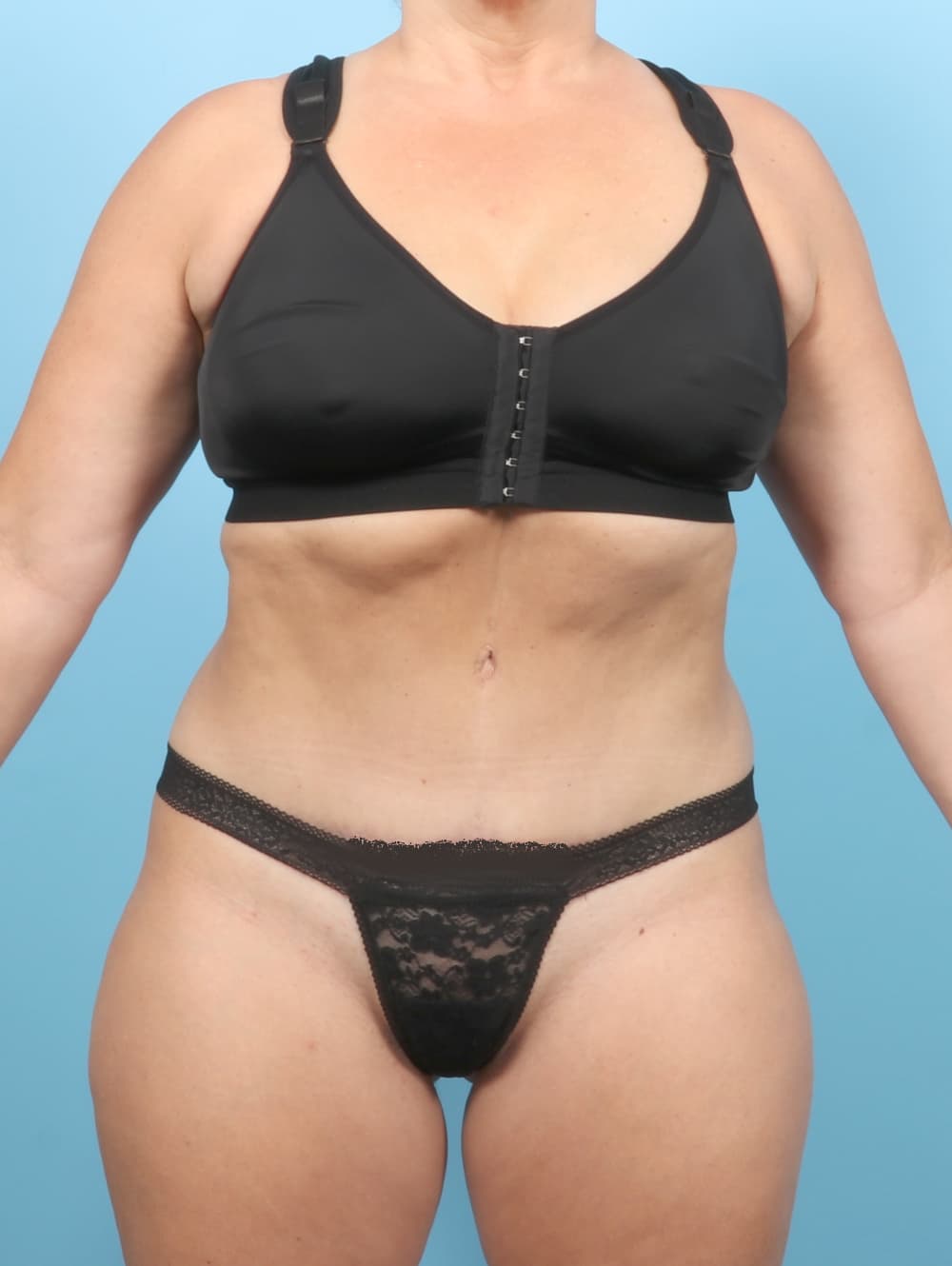 Tummy Tuck case #7265 after