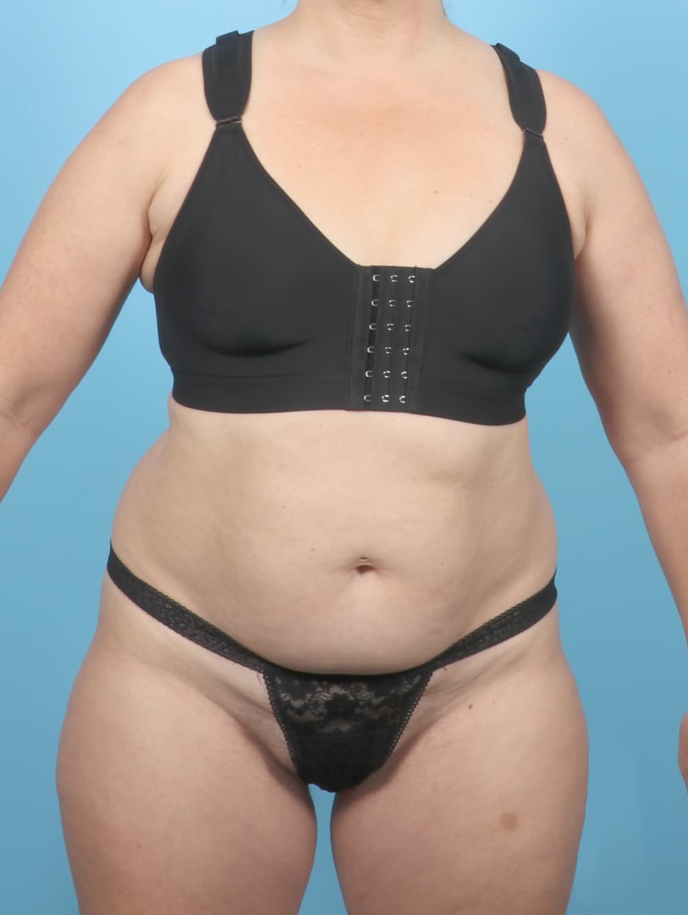 Tummy Tuck case #7265 before